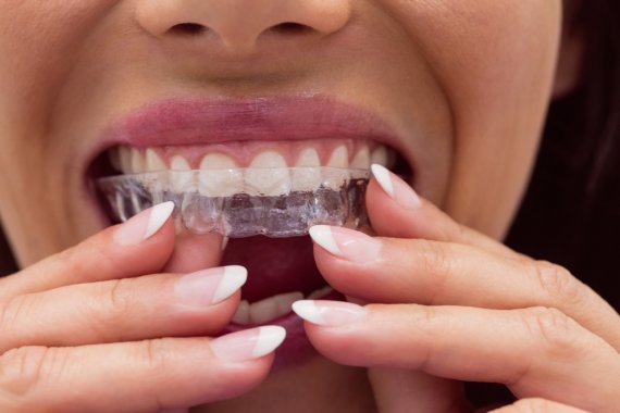 Diş Teli mi? İnvisalign mı?