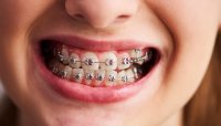 Neden Ortodontik Tedavi Görmeliyiz?
