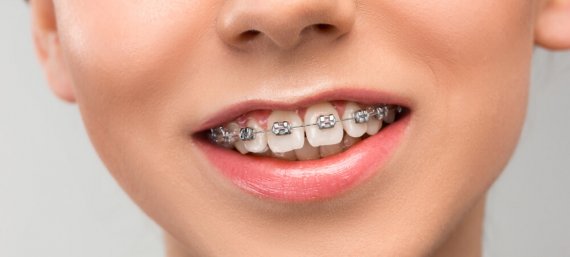 Ortodontik Tedavide Yaş Sınırı Nedir?